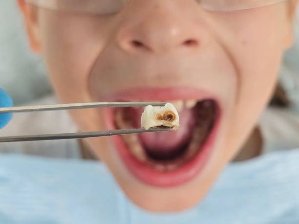 Best Chipped Tooth Repair Near Me  in Pontiac, IL